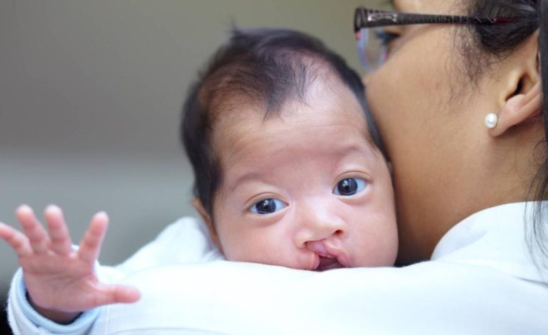 Los médicos especializados realizarán cirugías gratuitas para niños con un labio leporino del 6 al 10 de junio

 – En un click