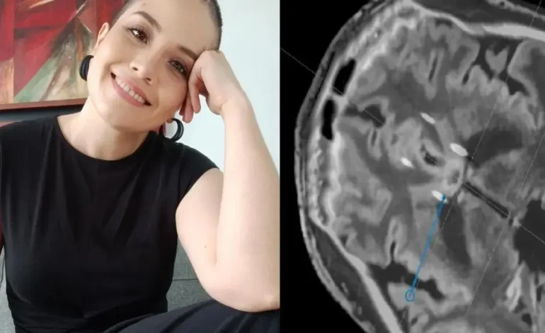  ¿Hay cirugía para mejorar la depresión? La historia de la mujer que se sometió a un procedimiento cerebral pionero

 – En un click