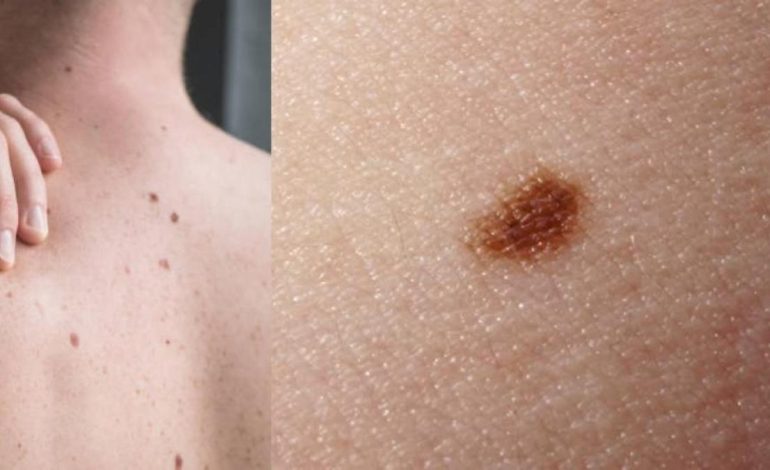  Día de comprobación de luna gratis busca prevenir el cáncer de piel

 – En un click