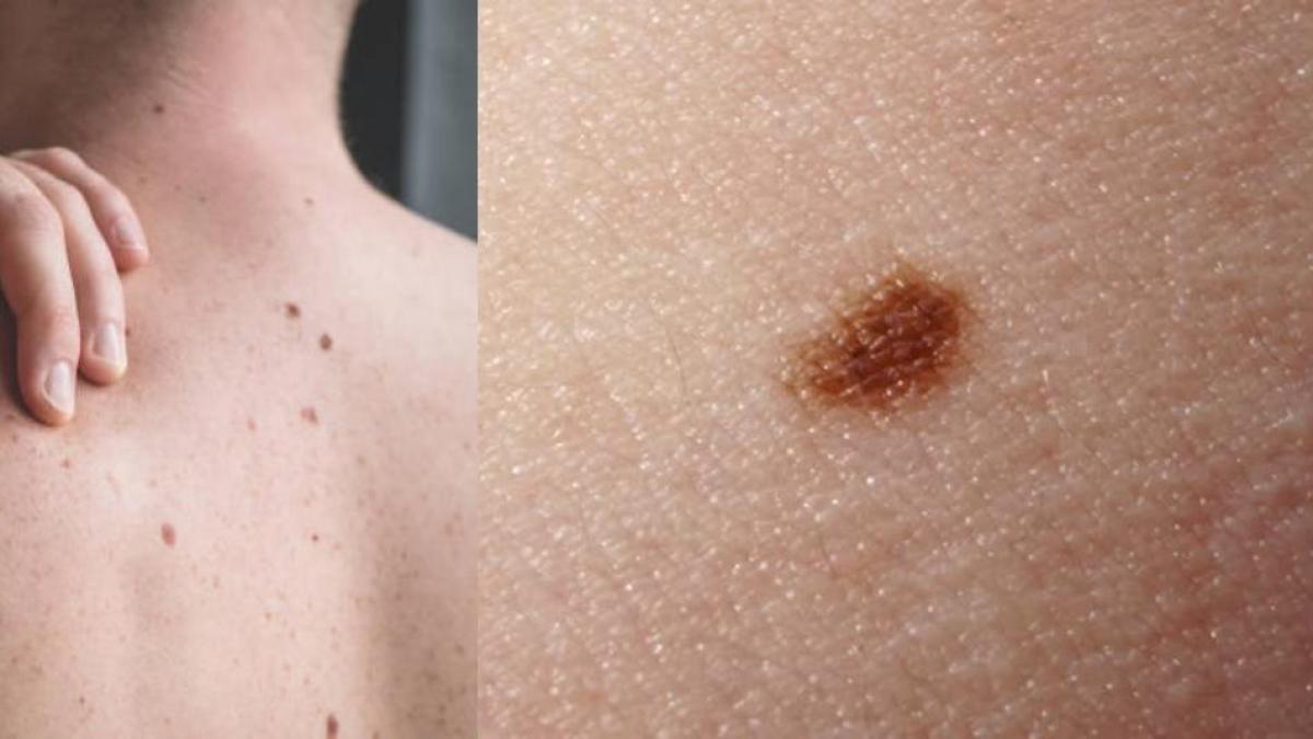 Día de comprobación de luna gratis busca prevenir el cáncer de piel

 – En un click