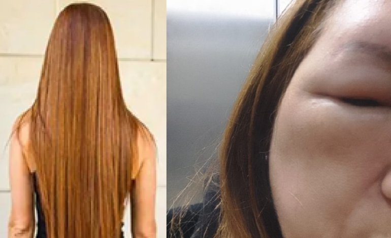 su cráneo y su cara se hincharon

 – En un click